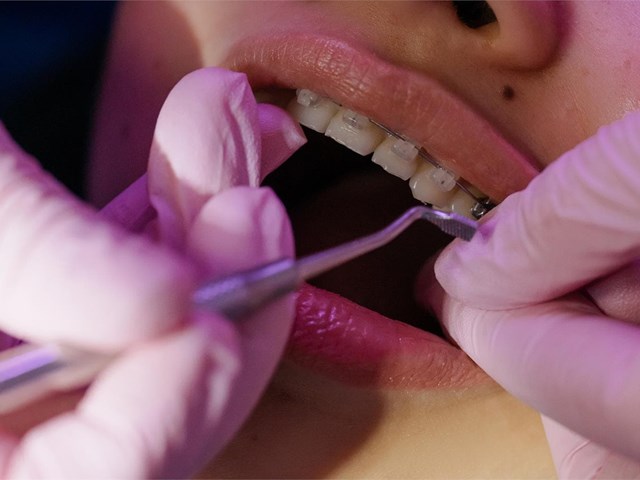 Características de los diferentes sistemas de ortodoncia