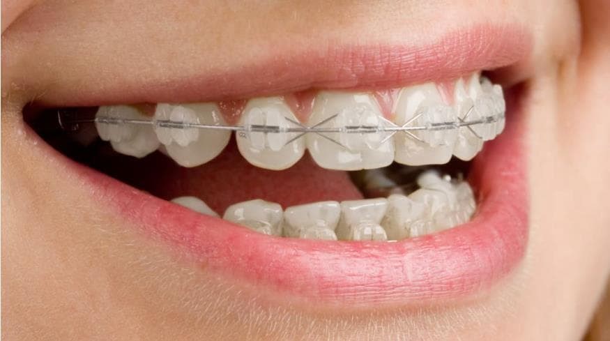 Características y ventajas de los brackets de zafiro