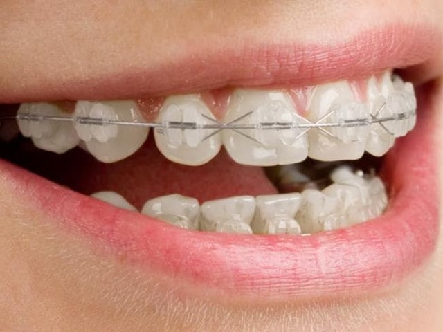 Características y ventajas de los brackets de zafiro