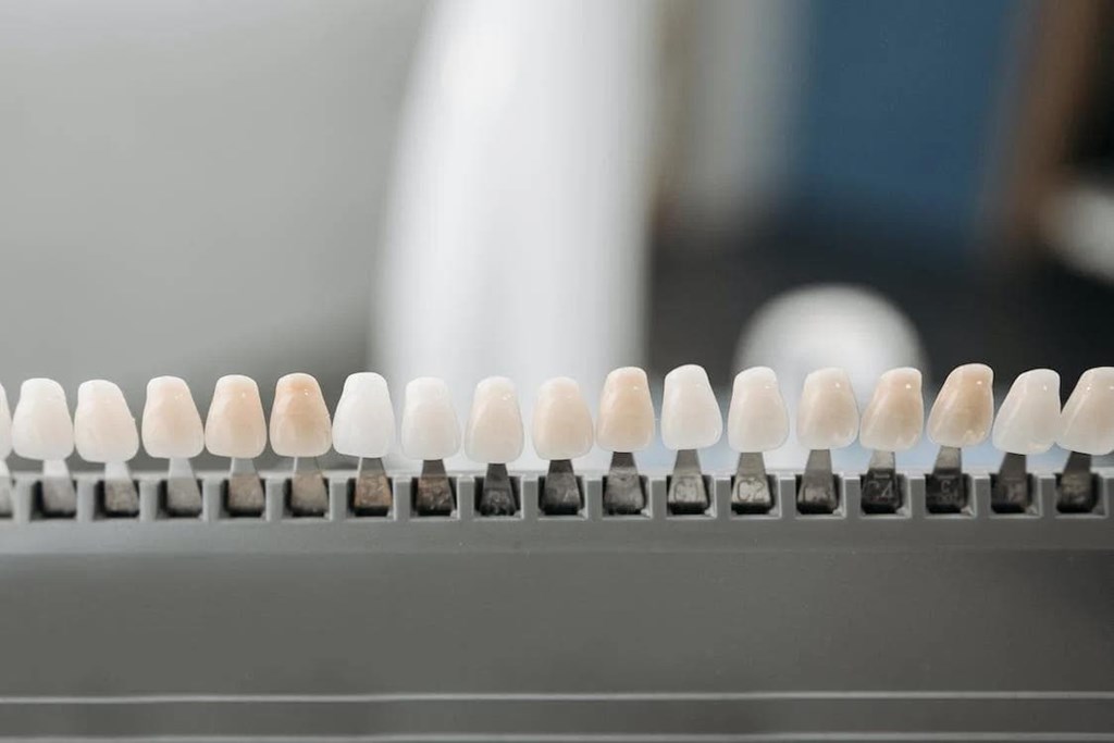 Carillas dentales: ¿cuándo utilizarlas?
