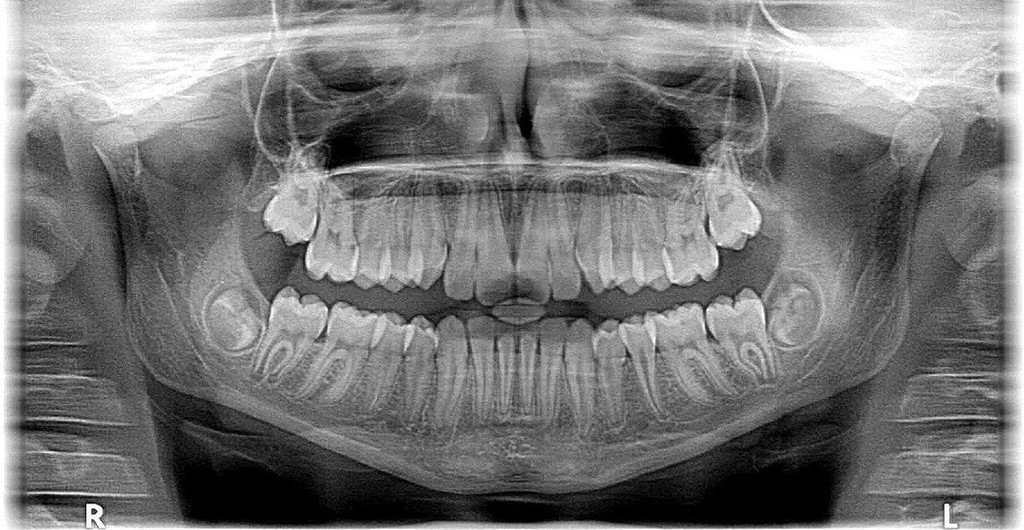 ¿Cómo se coloca un implante dental?