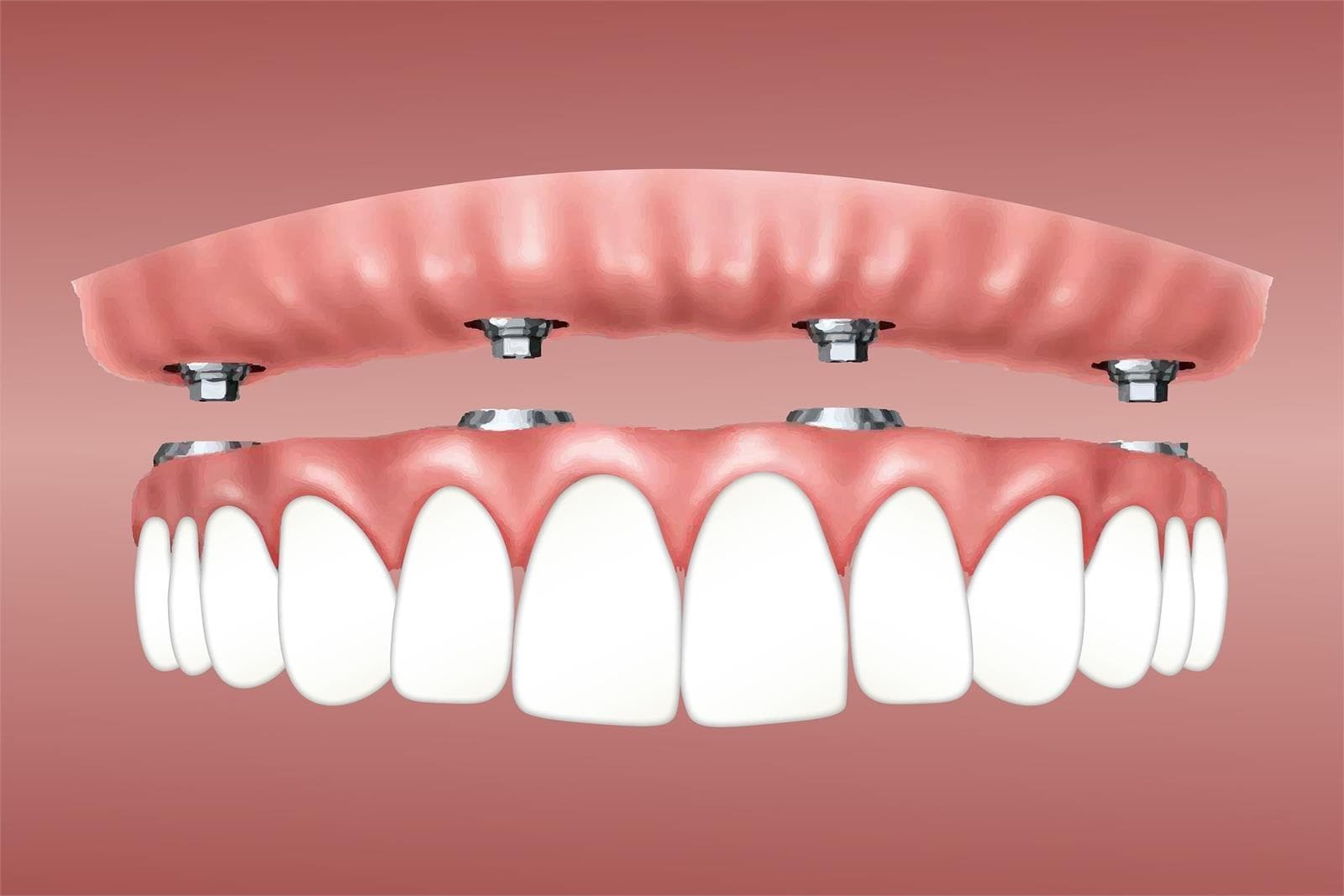 ¿Cómo se coloca un implante dental? - Imagen 1