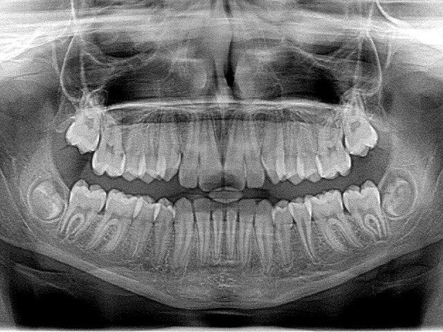 ¿Cómo se coloca un implante dental?