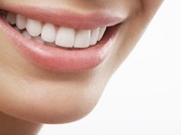 ¿Cuáles son las ventajas de las carillas dentales?