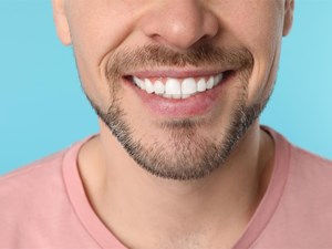 ¿Cuándo realizarse un blanqueamiento dental?