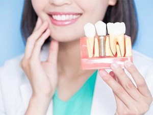 ¿Cuánto suelen durar los implantes dentales?
