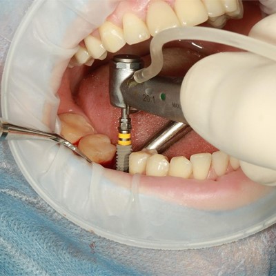 Diferencias entre prótesis e implante dental