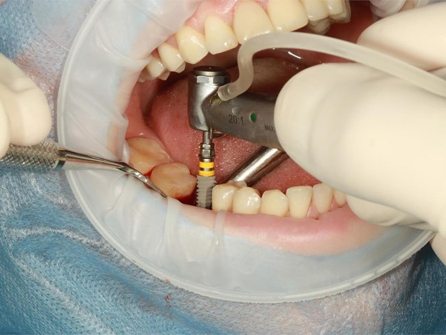 Diferencias entre prótesis e implante dental