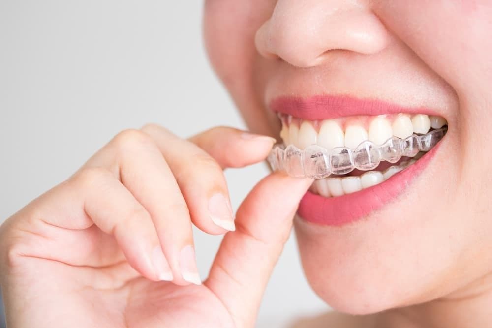 ¿Es más eficaz la ortodoncia invisible o los Brackets? 