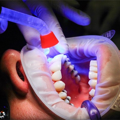 Expertos en blanqueamiento dental en Vilagarcía