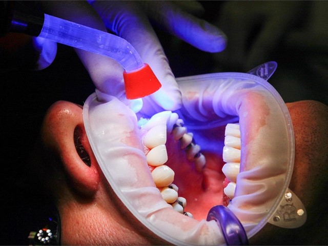 Expertos en blanqueamiento dental en Vilagarcía