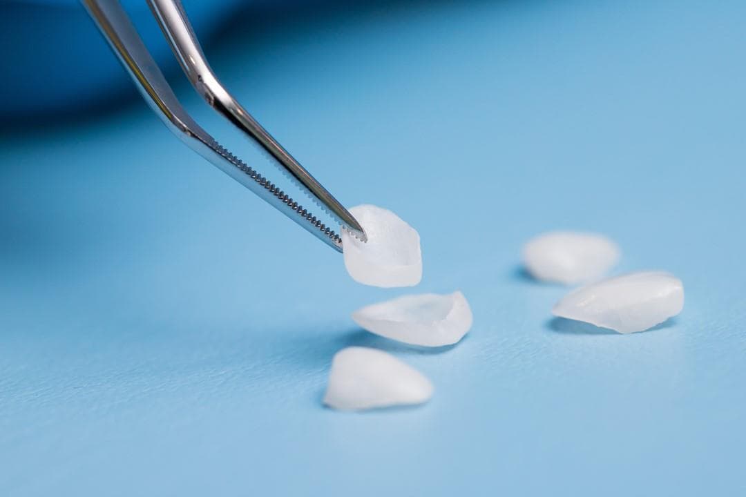 Carillas dentales sin tallado en Vilagarcía