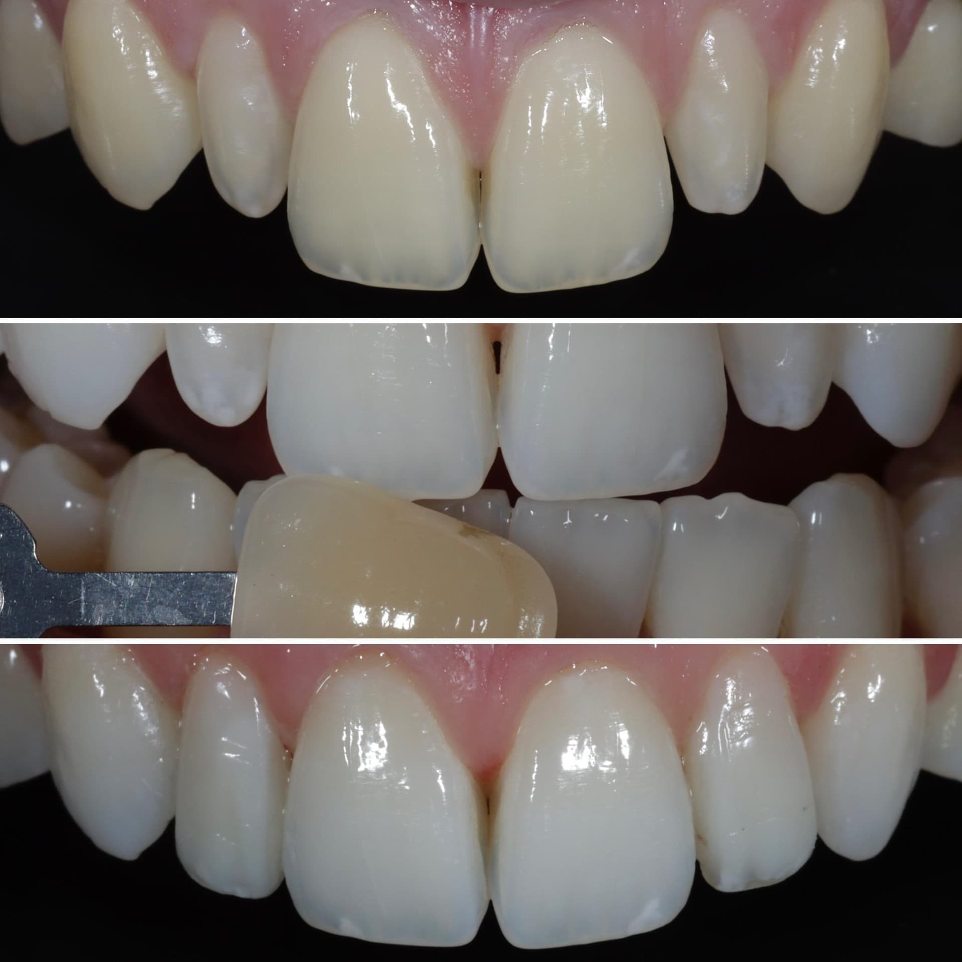 Blanqueamiento dental en Vilagarcía