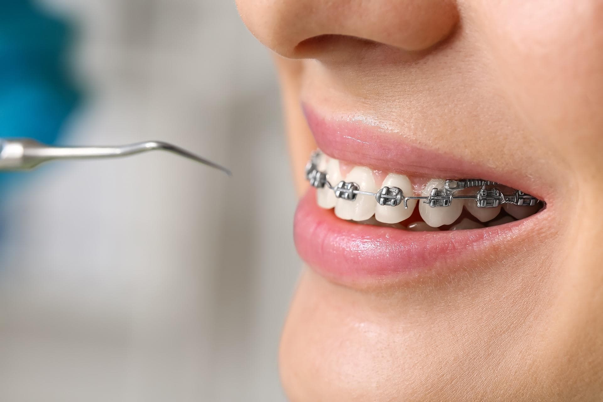 Ortodoncia con brackets metálicos en Vilagarcía