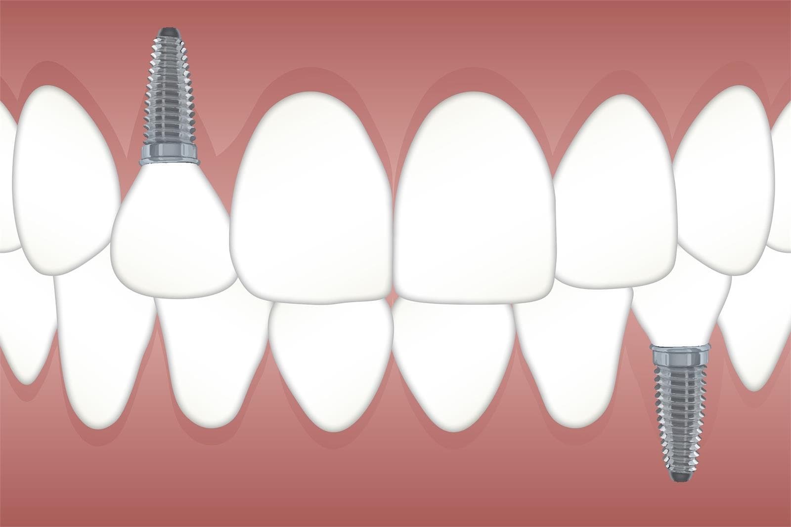 La importancia de contar con profesionales que realizan una limpieza exhaustiva de los implantes periódicamente - Imagen 2