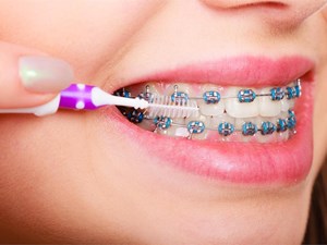 La importancia de la higiene bucal en pacientes con ortodoncia