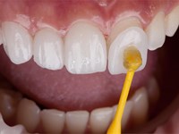 Los beneficios de las carillas dentales