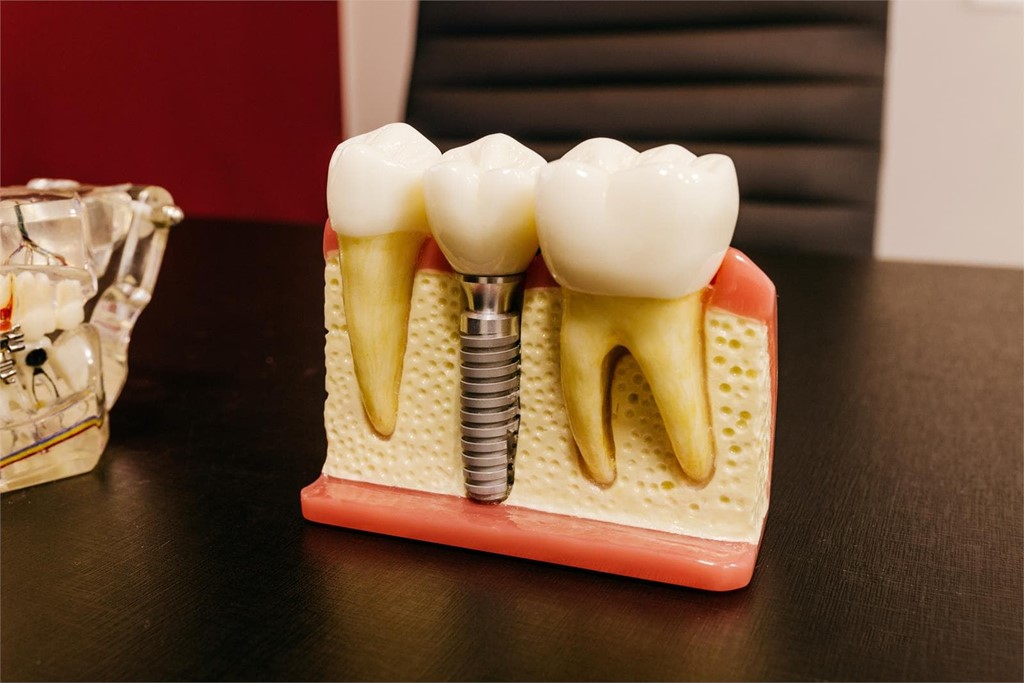 ¿Me puedo poner implantes si sufro de periodontitis?