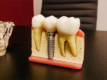 ¿Me puedo poner implantes si sufro de periodontitis?