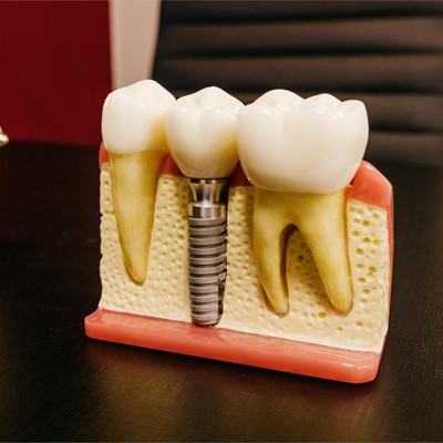 ¿Me puedo poner implantes si sufro de periodontitis?