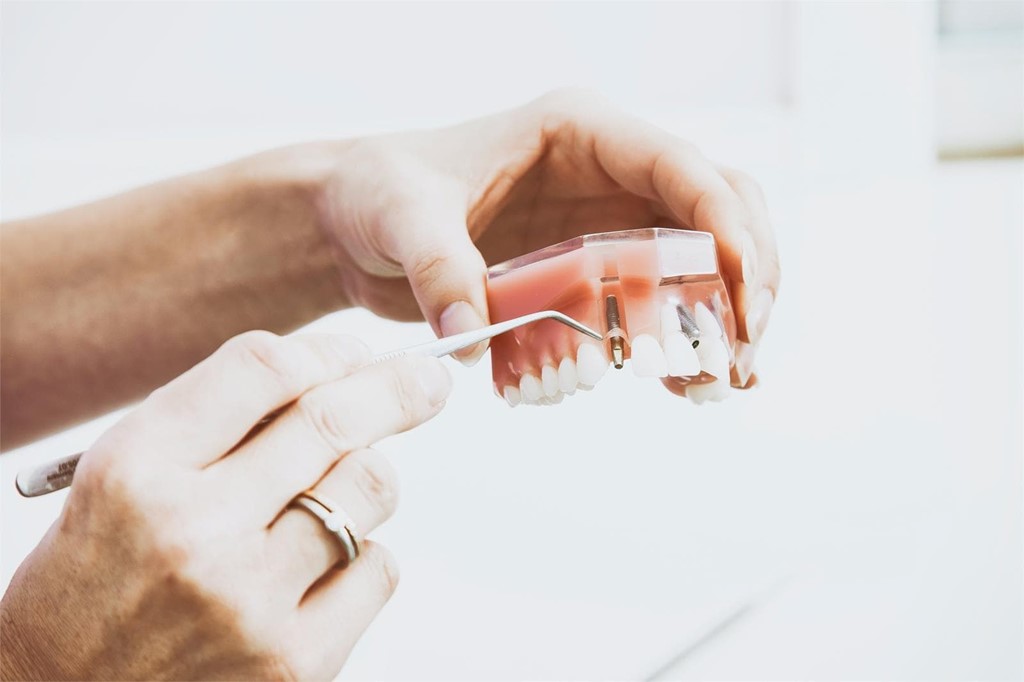 ¿No has descubierto todavía los beneficios de los implantes dentales?