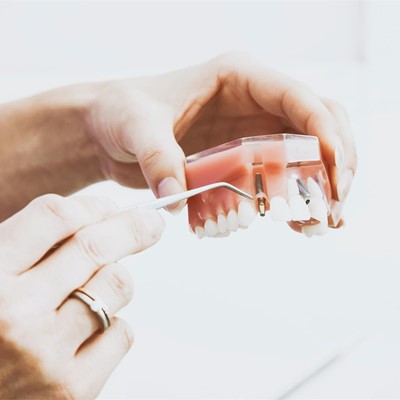 ¿No has descubierto todavía los beneficios de los implantes dentales?