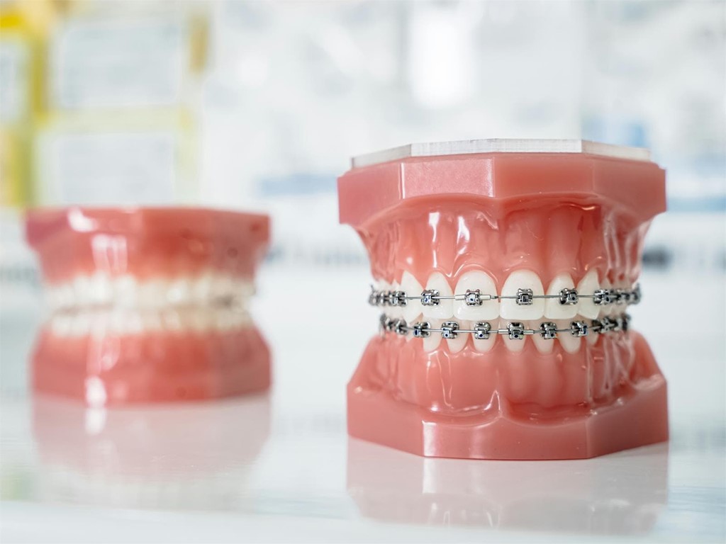 Ortodoncia e higiene: descubre cómo los brackets pueden ayudar a mejorar tu salud bucodental