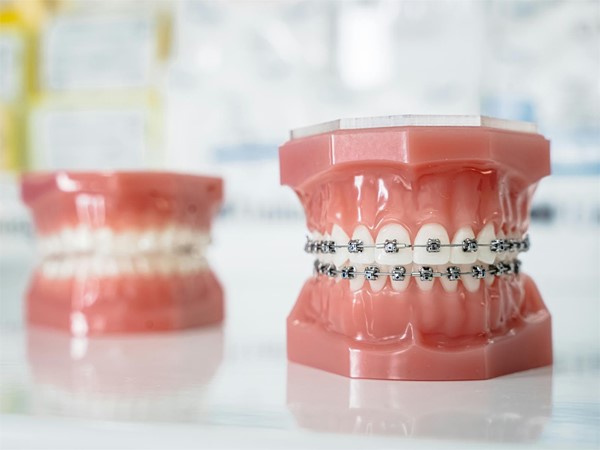 Ortodoncia e higiene: descubre cómo los brackets pueden ayudar a mejorar tu salud bucodental