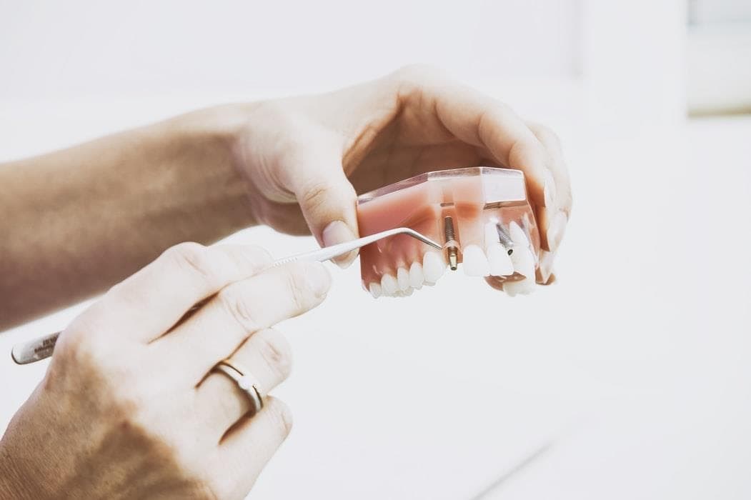 ¿Qué es un implante dental? - Imagen 1