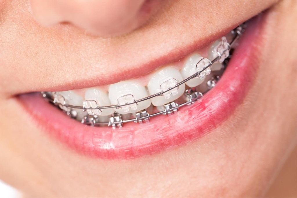 ¿Qué tener en cuenta a la hora de elegir un tratamiento de ortodoncia? 