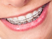 ¿Qué tener en cuenta a la hora de elegir un tratamiento de ortodoncia? 