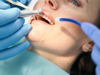 ¿Qué tener en cuenta después de una endodoncia?