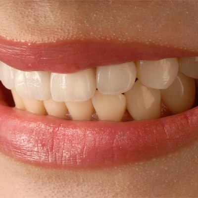 Ventajas de las carillas dentales