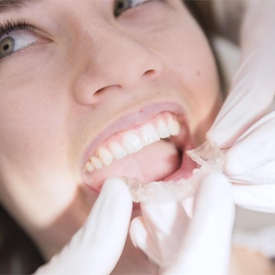 Visita nuestra clínica dental el 26 de junio, ¡Descuentos especiales para aparato Invisalign!