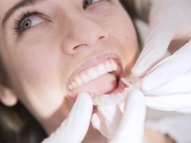 Visita nuestra clínica dental el 26 de junio, ¡Descuentos especiales para aparato Invisalign!